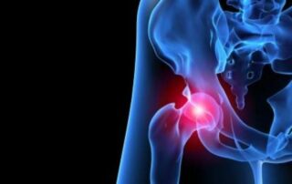 QUÉ ES EL CHOQUE FEMOROACETABULAR