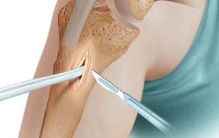 LCA- RODILLA