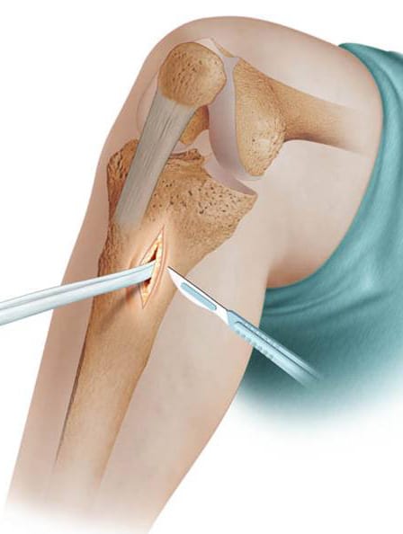 RECUPERACIÓN DEL LIGAMENTO CRUZADO ANTERIOR (LCA)