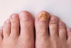 HONGOS EN LAS UÑAS DEL PIE