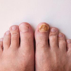 HONGOS EN LAS UÑAS DEL PIE HONGOS EN LAS UÑAS DEL PIE. TODO LO QUE NECESITAS SABER SOBRE LA ONICOMICOSIS.