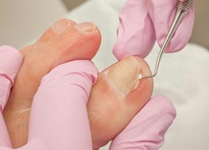 uña encarnada valencia 2 ¿QUÉ ES UNA UÑA ENCARNADA? APRENDE A TRATAR Y PREVENIR LA ONICOCRIPTOSIS.